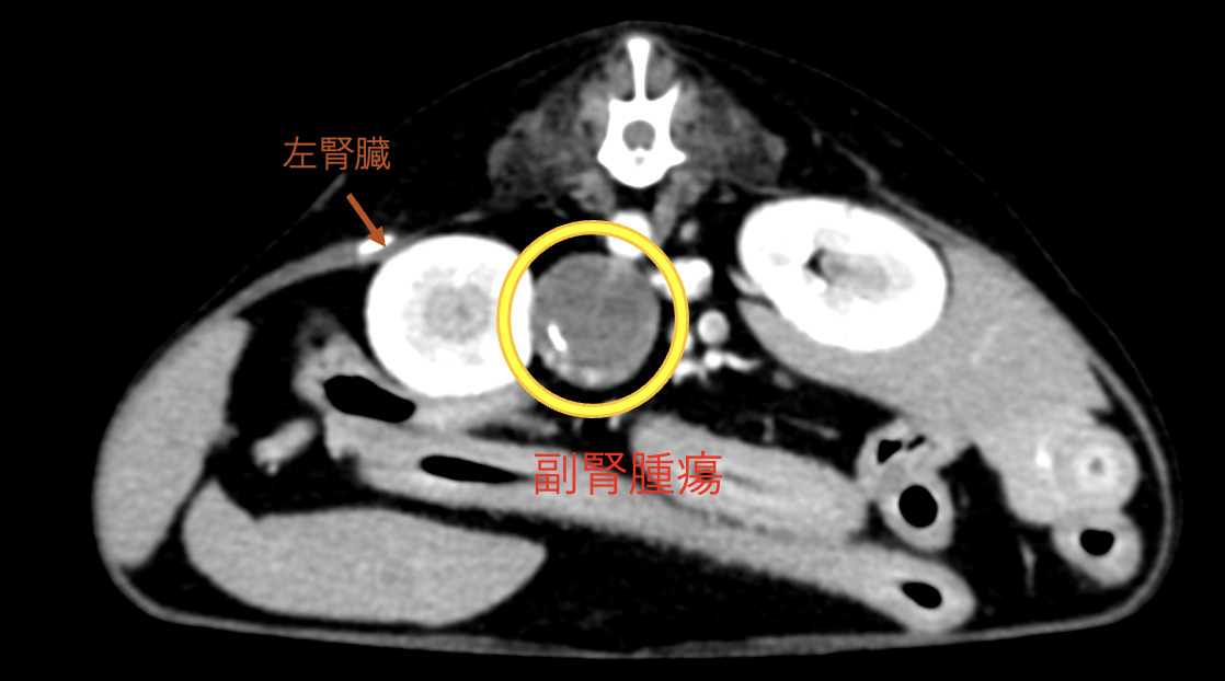 腎臓がん - 主な病気と治療方法 - 名古屋大学大学院医学系研究科