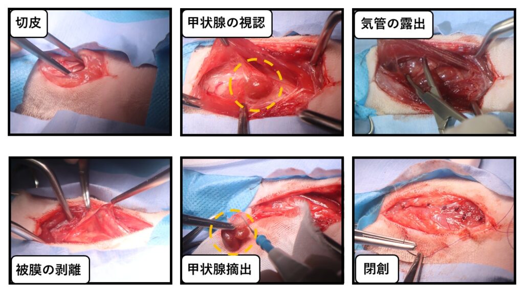 甲状腺摘出の実際の手術写真