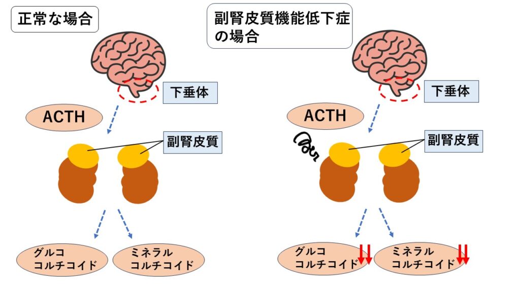 副腎皮質機能低下症のイラスト