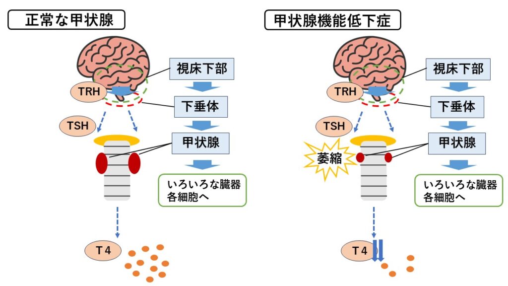 甲状腺機能低下症とは?