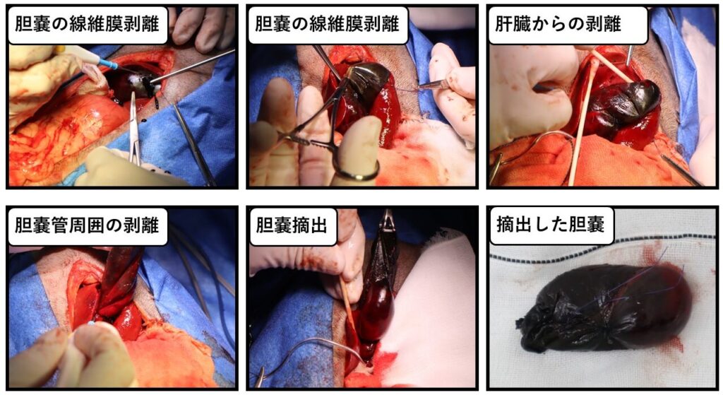 胆嚢摘出術の実際の写真