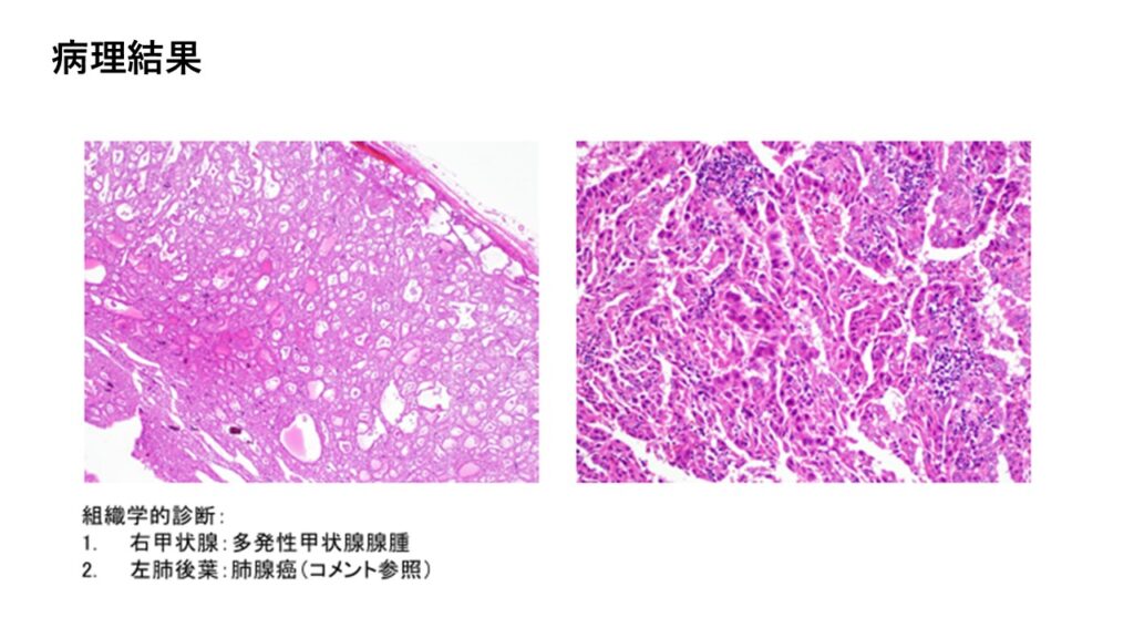 病理学的検査の結果