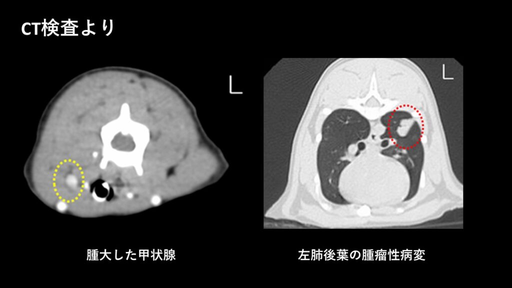 甲状腺腫瘤および肺腫瘤のCT検査結果
