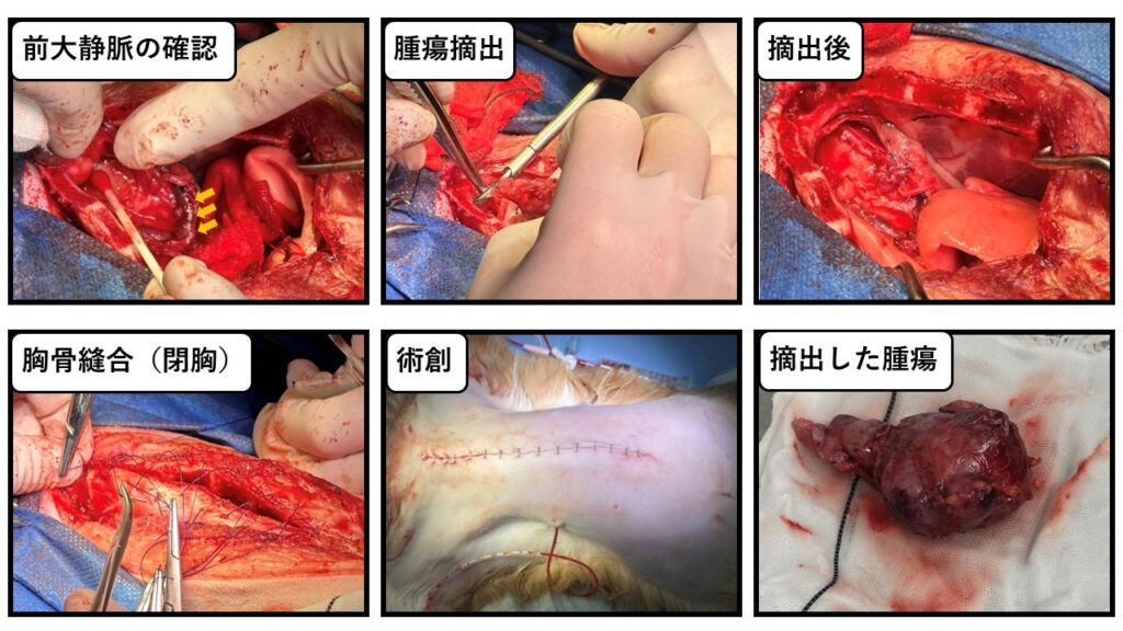胸腺腫摘出の実際の手術写真