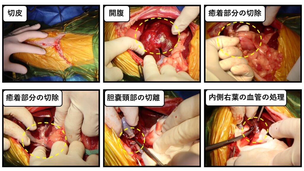 肝臓腫瘍および胆嚢一括摘出-1