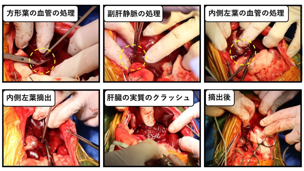肝臓腫瘍および胆嚢一括摘出-2