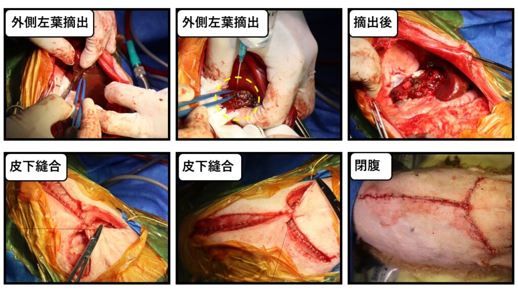 肝臓腫瘍および胆嚢一括摘出-3