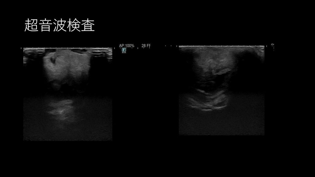 眼の超音波検査